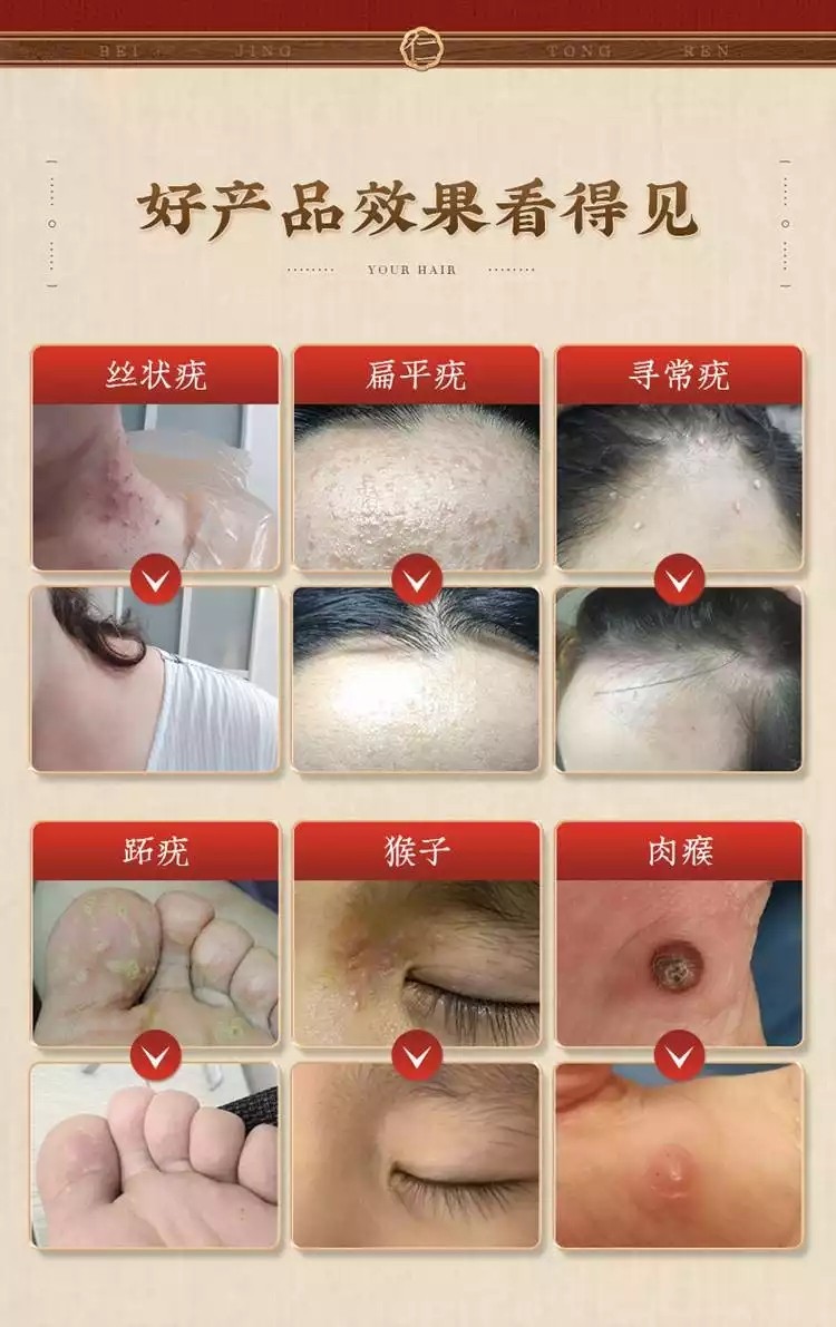 白云山除疣凝露去尖锐湿疣肉粒刺猴子可搭5氟脲嘧啶软膏疣必治灵hpv