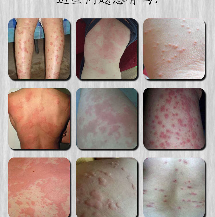 草本乳膏慢3天【复发】止痒膏真菌风疹风团皮肤瘙痒过敏 1盒装【图片