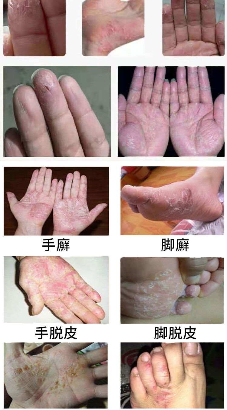 水泡型手i癣足i癣牛皮ill癣手足i癣水泡手痒脱皮干裂皮ll炎湿ll疹止痒