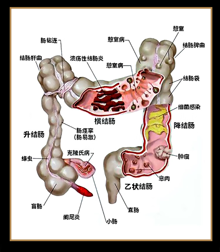 大肠病变病理解剖模型肠道疾病人体结肠病变模型人体器官解剖模型人体