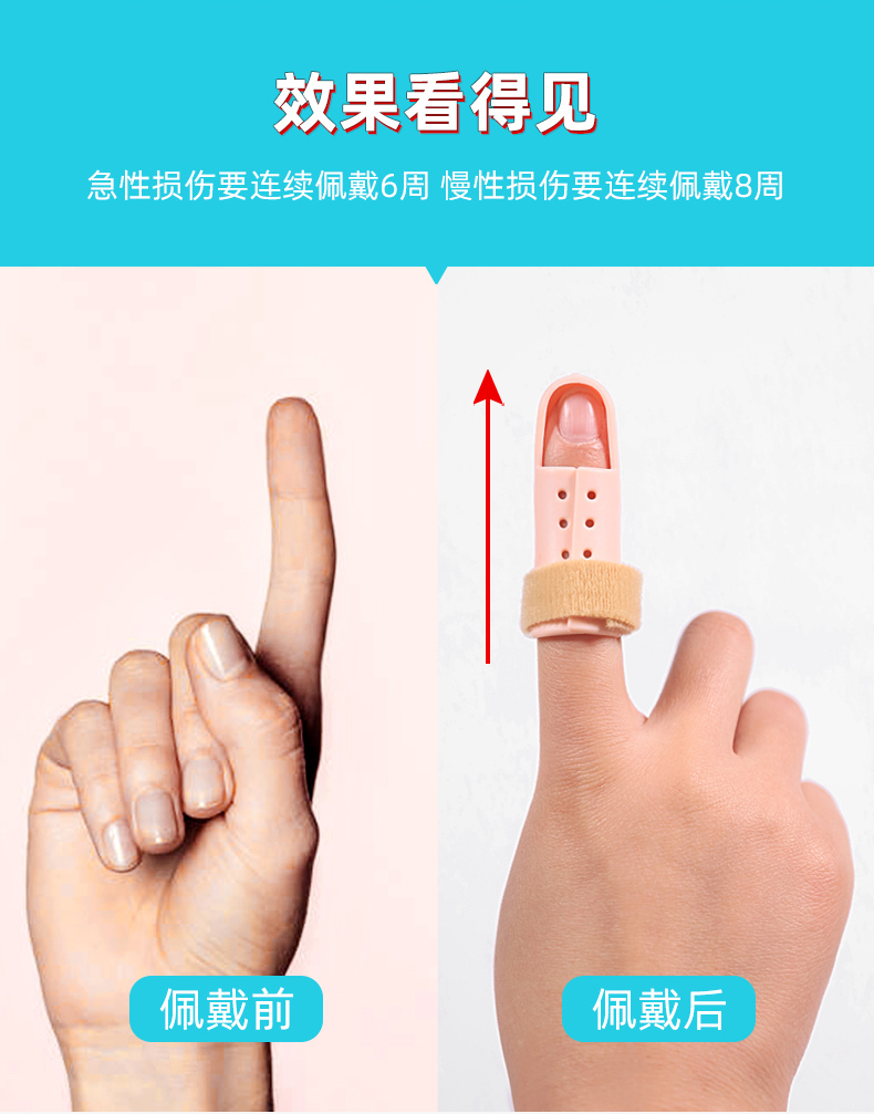 拇指受伤固定手指弯曲矫正骨折固定指套夹板支具关节变形支架保护锤状
