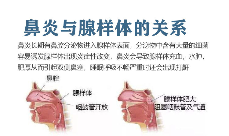 适用于过敏性鼻炎贴儿童鼻塞鼻窦鼻甲肥大腺样体肥大中药贴买5带38盒