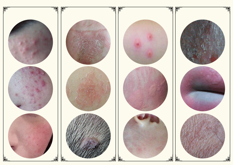 女性阴囊皮脂腺图片图片