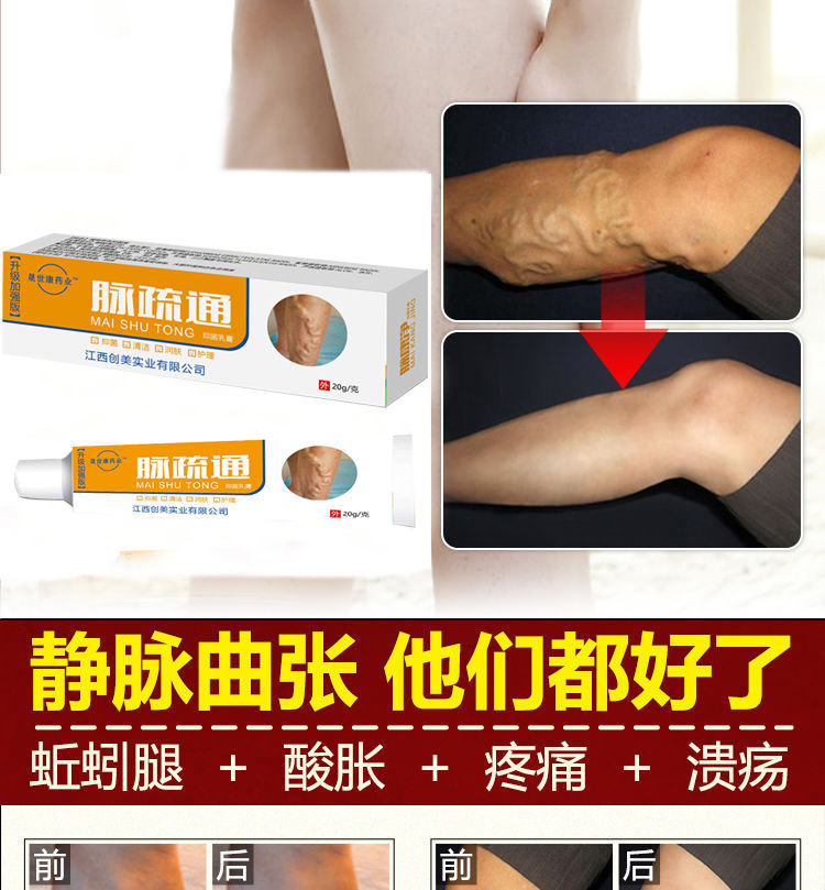【50岁老人送】专治静脉曲张药膏蚯蚓腿青筋腿部凸起修复 一支装【无