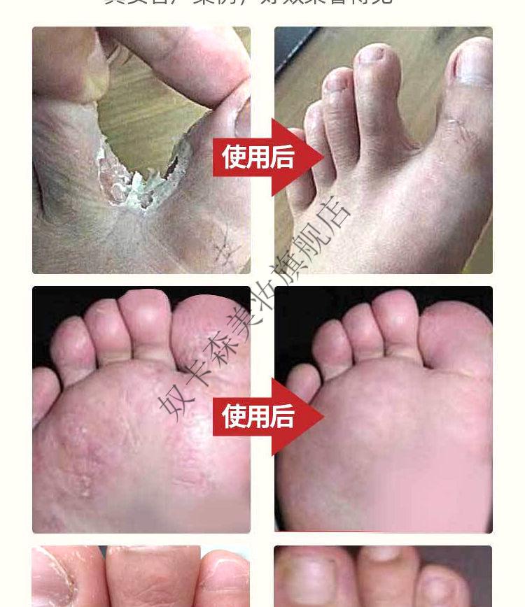 喷剂王脚臭脚汗克星止痒喷雾味喷剂依漾南京同仁堂艾草足浴包30小包