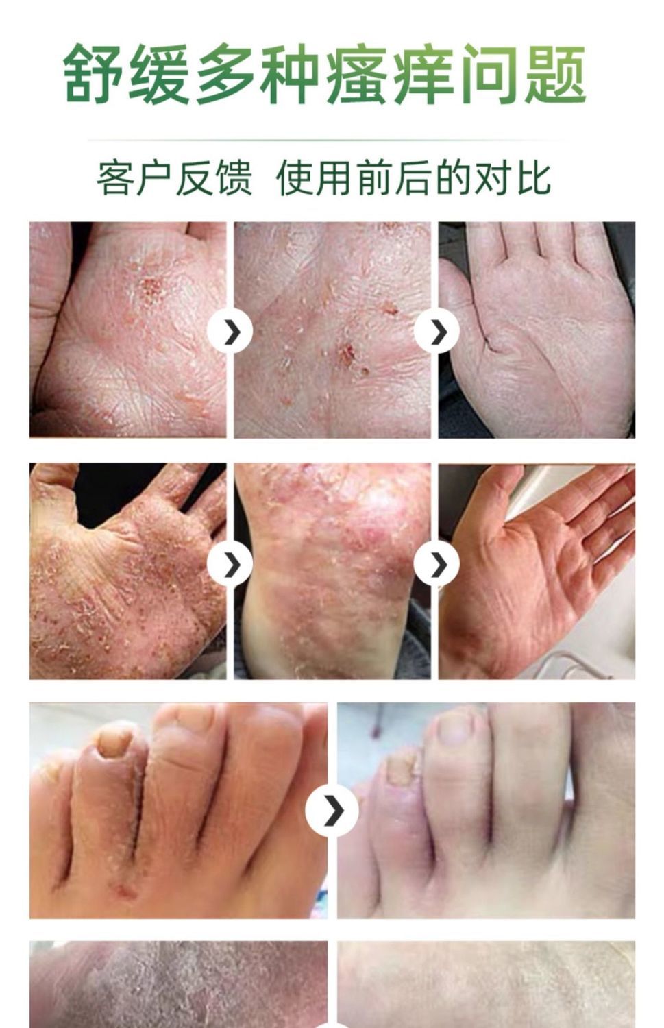 京康i恩皮肤乳膏京康恩2合1去汗膏皮手脚水泡脱皮干