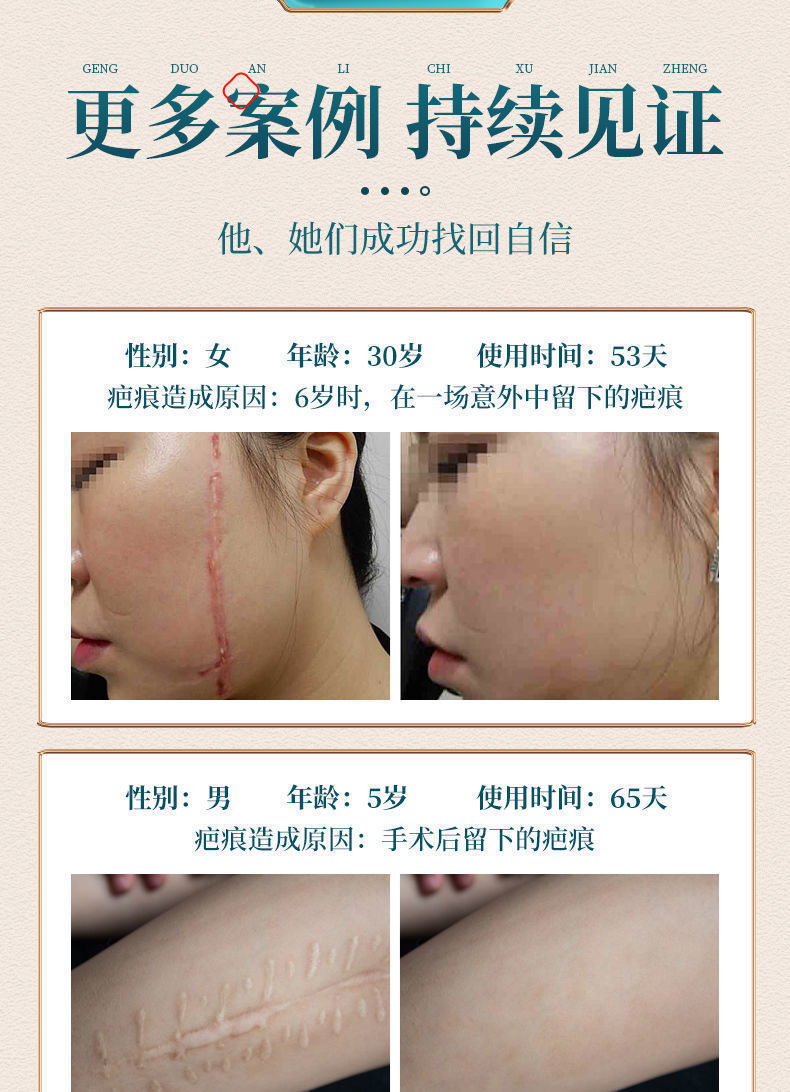 医用疤痕贴一抹消去无痕增生修复剖腹产手术伤疤脸上凹凸痘印 【医师