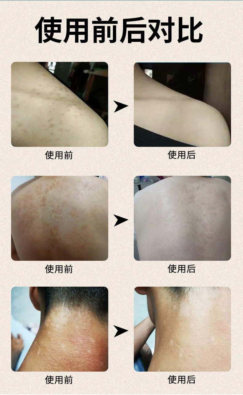 大药房直售 妙丹堂汗斑净汗斑香露白斑色素不均抑菌喷剂汗斑专用皮肤