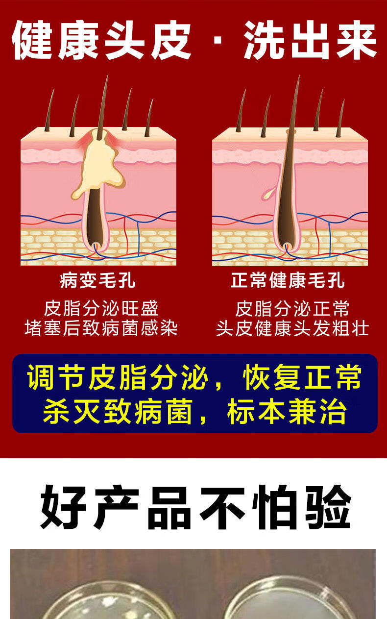 毛囊炎沐浴i露头皮毛囊焱炎脂溢性皮ii炎洗发水去屑止痒红i斑痛脓包