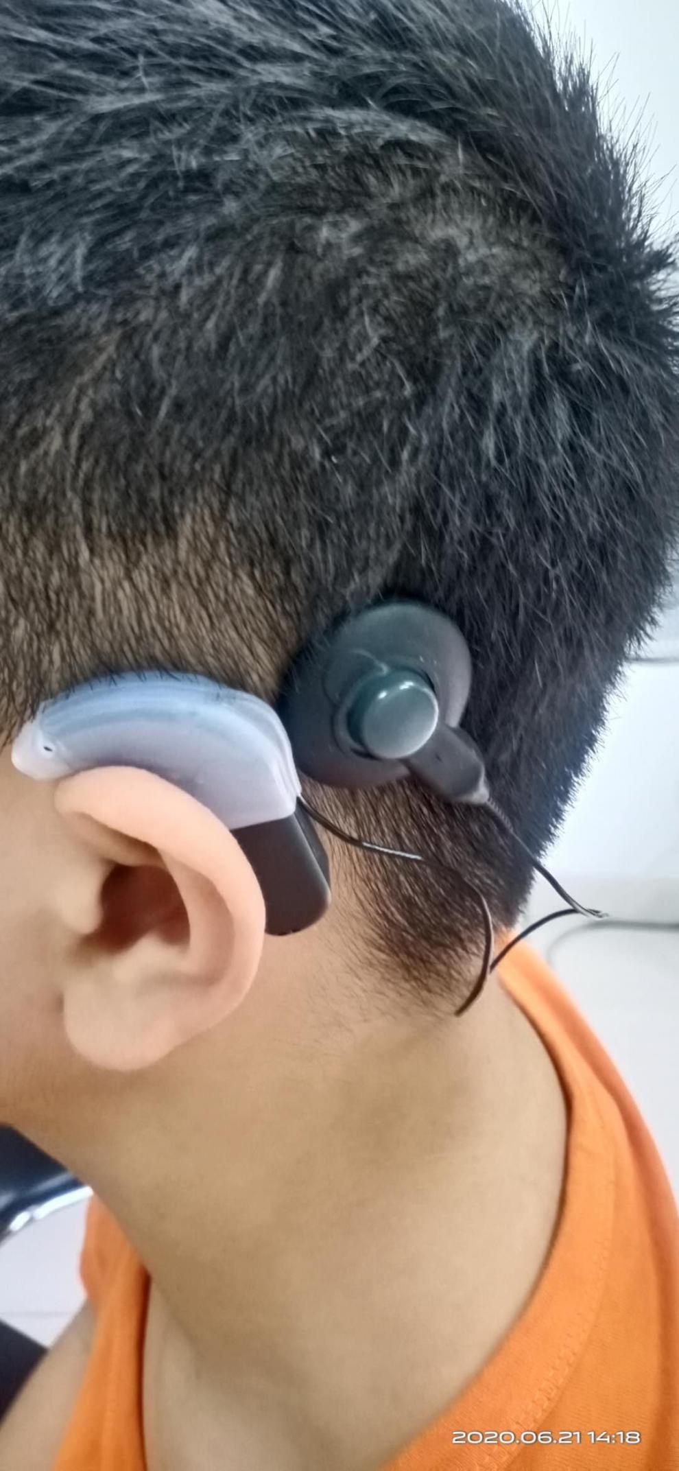 人工耳蜗,奥地利opus2款,xs,防汗套,线圈套,耳锁.