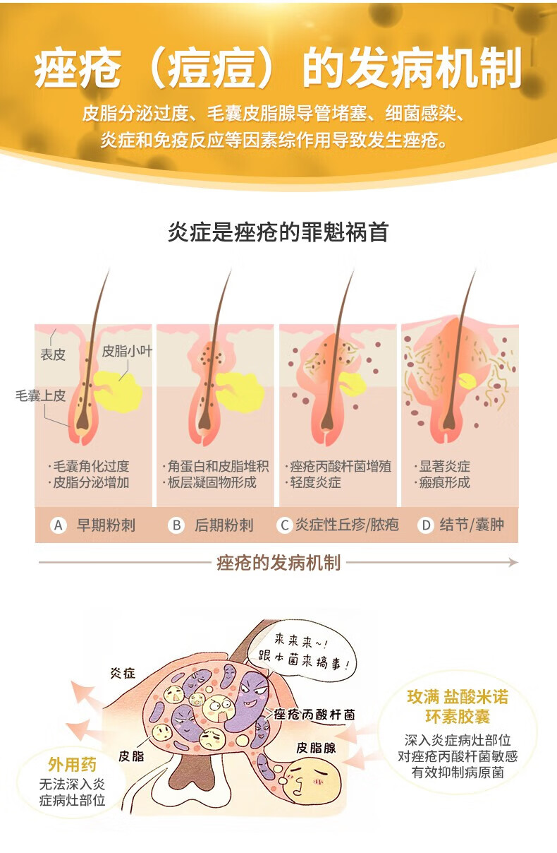 玫满 盐酸米诺环素胶囊50mg*20粒美满霉素淋病尿道炎毛囊炎尿路感染的