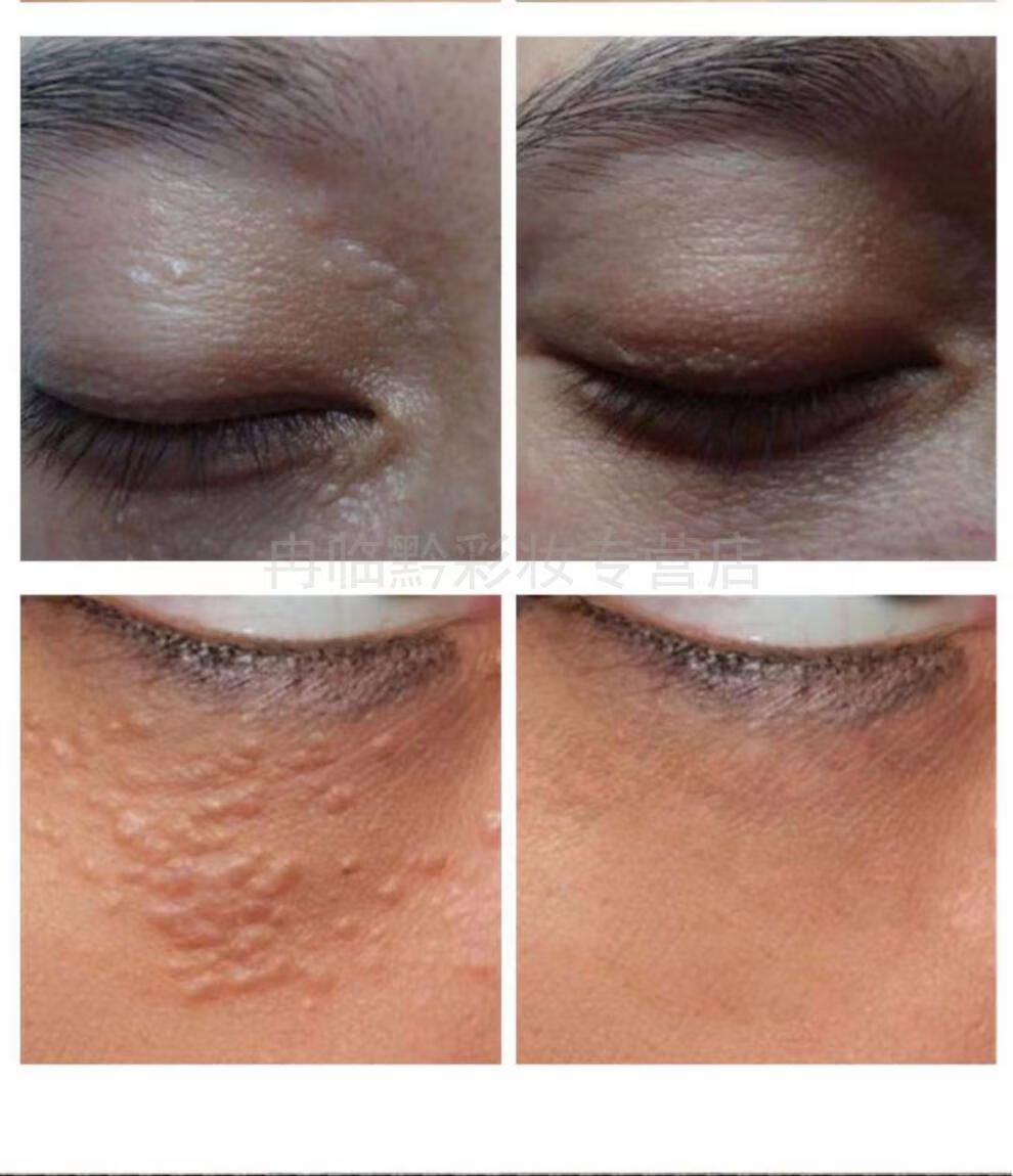 南京同仁堂消脂肪粒祛除汗管粒油脂粒祛扁平粒专用眼霜膏神器 【单支