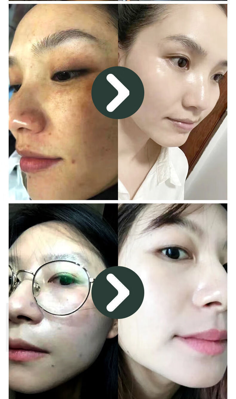 斑点老年斑雀斑美容院专用美颜祛班精华液 祛斑液1瓶(无尴尬期)【图片