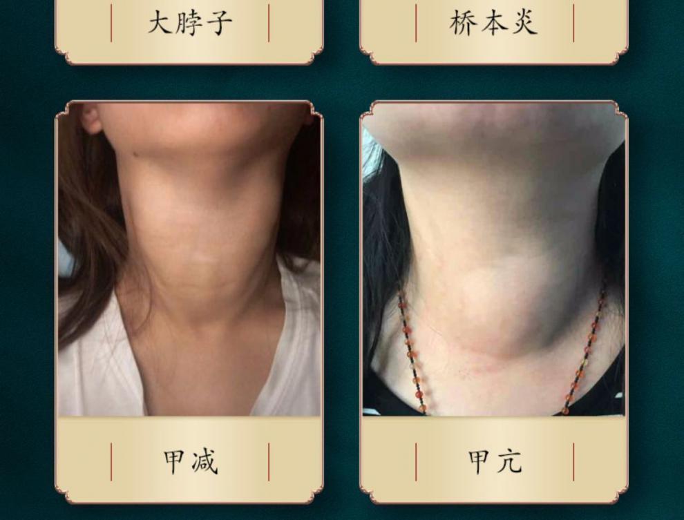 【官方自营】甲状腺结节贴【李时珍】李时珍甲状腺贴散结贴甲亢甲减贴