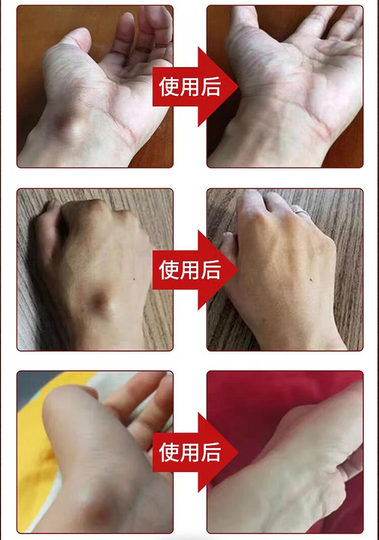 乐天仁达柯瑞森一号腱鞘鼓包扭伤大拇指疼痛手指关节乐天仁达柯瑞森1