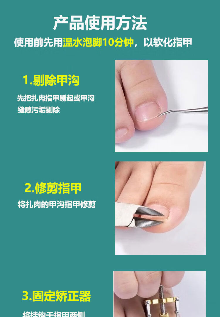 甲沟炎指甲器嵌甲纠正甲填充垫片脚趾甲往肉里长 甲沟隔离垫【30个】