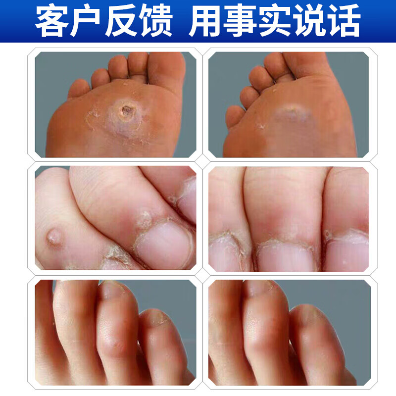 【官方】牛氏茧艺清茧卫士脚垫脚茧胼胝硬茧去手茧刺窝脚刺猴老茧猴子