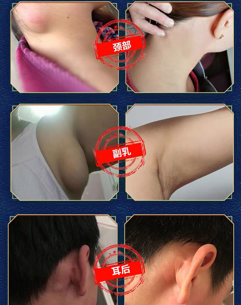伊夏 淋巴通络膏腮边颈部下巴去硬块耳后腮帮子散结腋下副乳去副乳