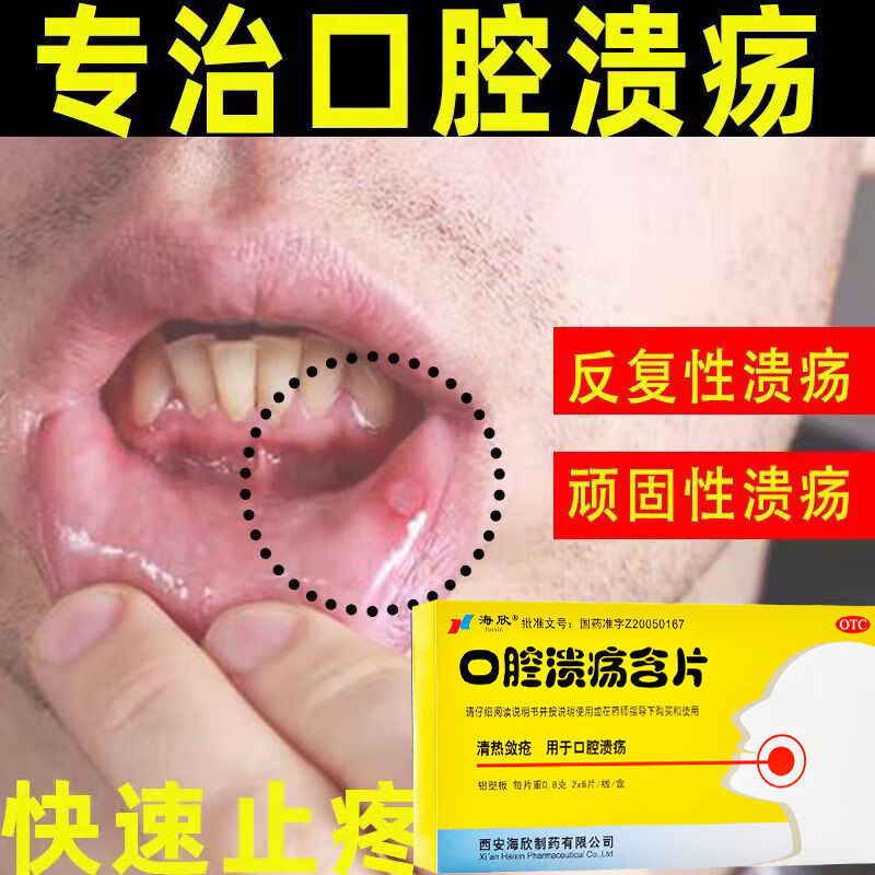 口腔溃疡药图片