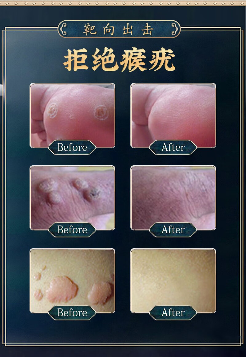 除疣疣立净去猴子肉粒去刺猴丝状优脖子颈部疣瘊灵去除皮赘疣必清 买