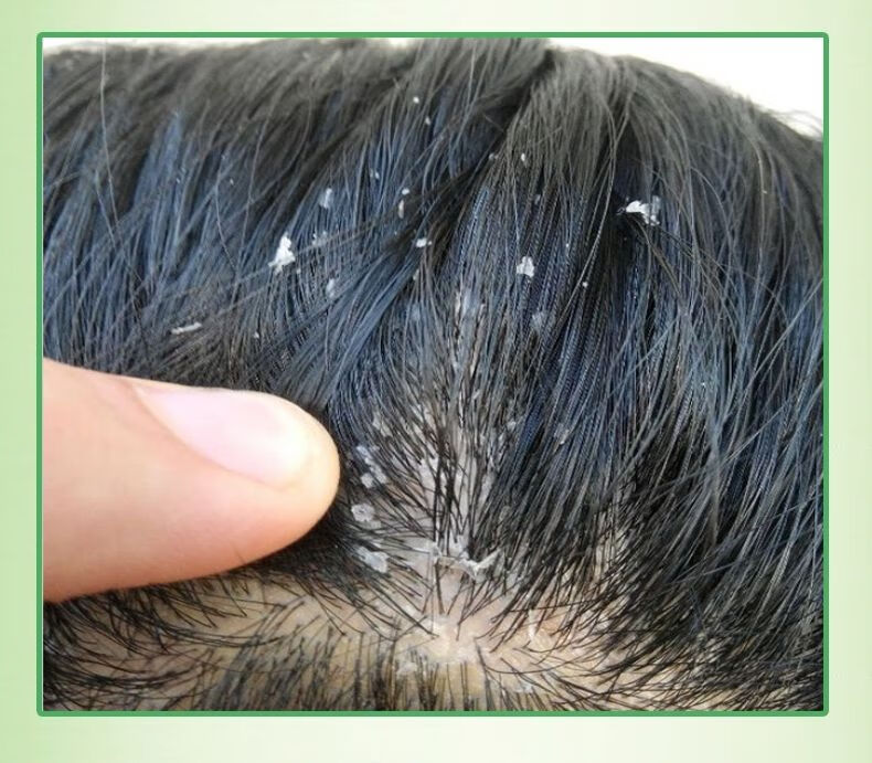 官方旗舰儿童去屑止痒洗发水除螨去剪发虫植物洗发露学生专用315岁