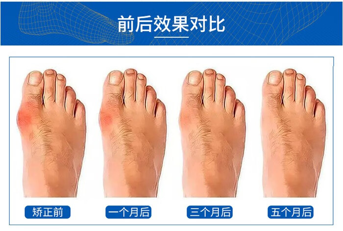 日本脚趾器大拇指外翻器脚趾重叠五指分趾器小脚趾器儿童款白色两双