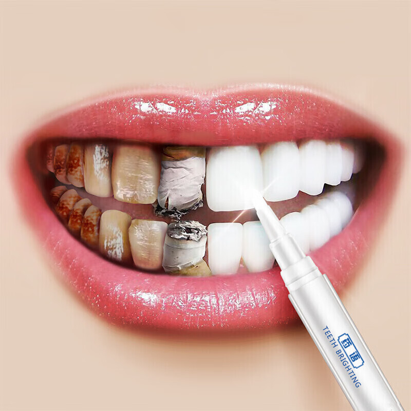 牙齿漂白剂牙齿漂白剂洗牙齿污垢抽烟牙齿黄牙齿黑色污垢牙齿黄怎么办