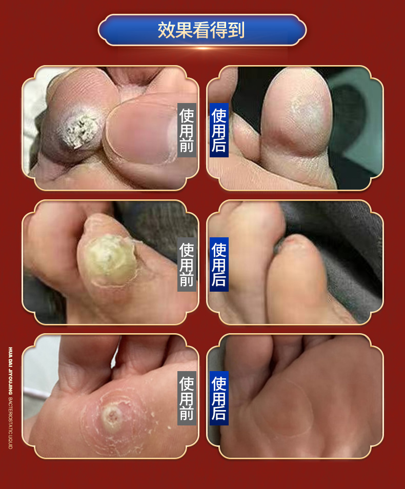 花带2号鸡尤净老茧膏灵官方花带2号轻度体验装一盒装