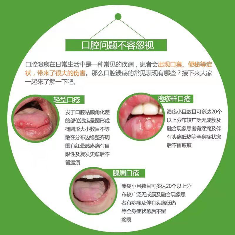 京選優品潰舒靈西瓜霜口腔潰瘍噴霧劑30ml瓶異味上火口瘡舌頭起泡