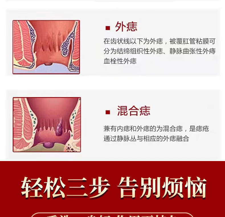 痔l疮中薬坐浴熏洗i薬庤i庤i膏肛门消i肉i球治i肛i周脓肿ii愈合外洗薬