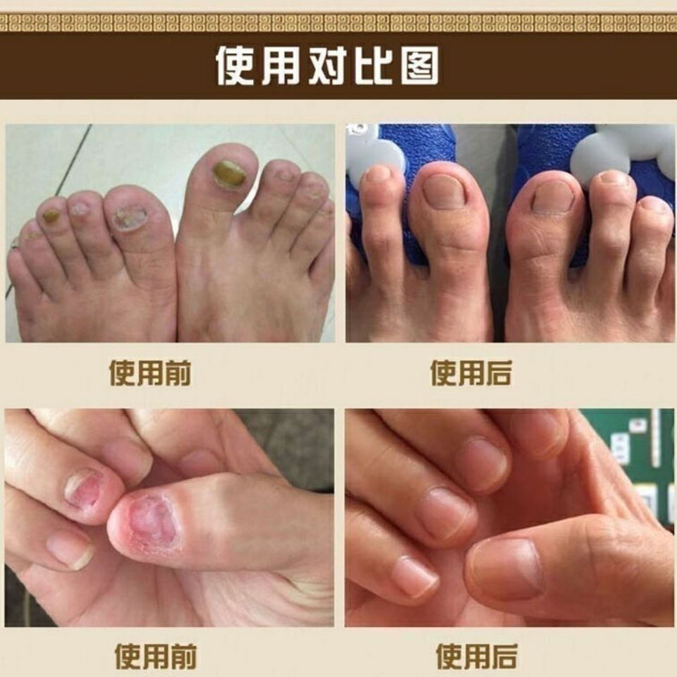 滴甲王灰指甲液灰指甲治坏甲软甲手脚趾甲增厚灵甲净灵德州康柏滴甲王