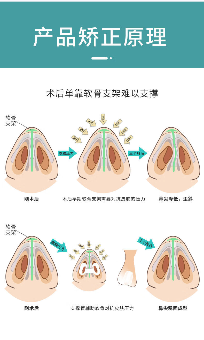 肋软骨隆鼻支架图解图片