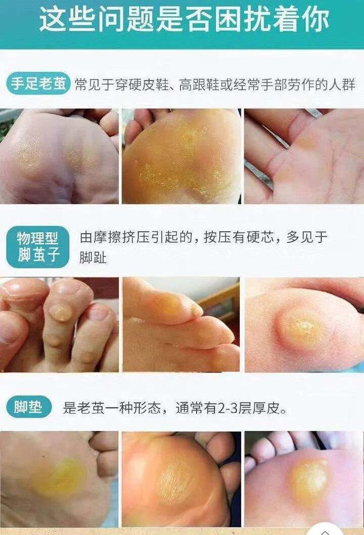 茧立净去老茧子手脚厚茧皮脚底脚垫死皮膏清关节脚趾老茧