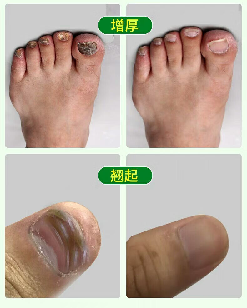 软函甲康灵新快速灰指甲专用膏无痛脱甲增厚甲沟炎买二一lj3