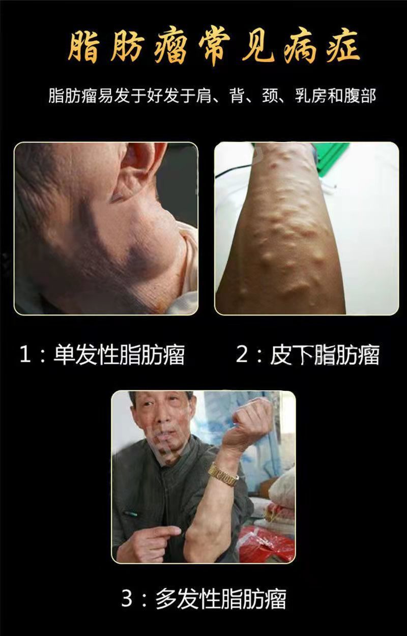 脂肪瘤去除神器快三天专消单发性多发性脂肪瘤硬块囊肿喷剂单盒装轻度