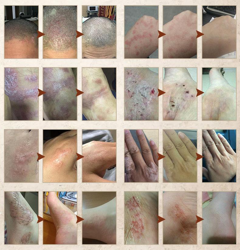 尼坤拓实膏软膏起水泡止痒草本手痒脱皮泡诊湿诊1支装喷剂