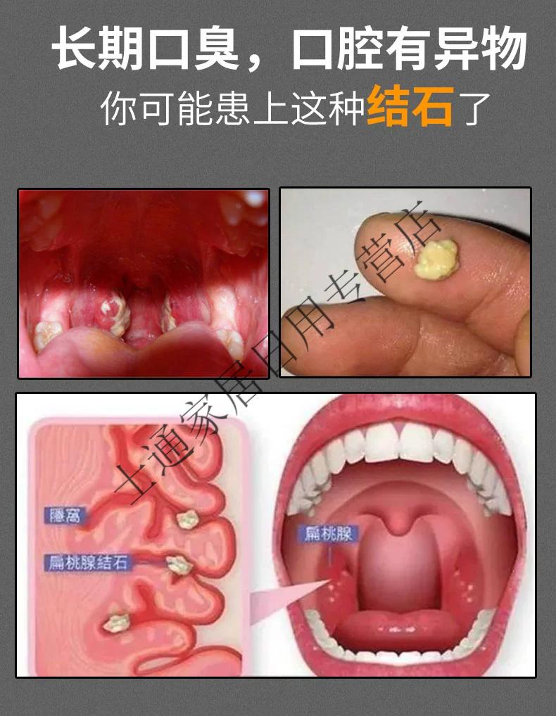 扁桃体结石位置图片图片