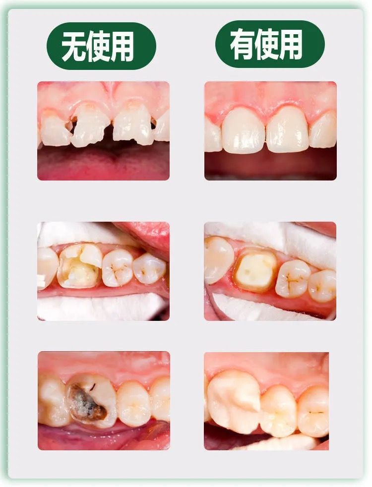 益生菌牙膏补牙洞图片