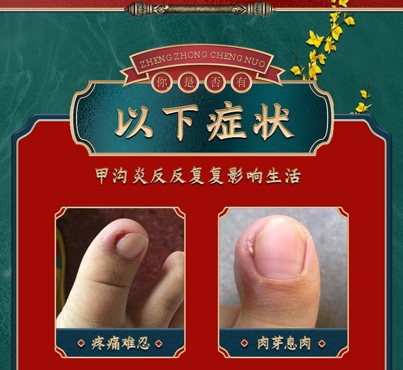 官方旗舰精品浅i米草14号普圣友甲勾二号乳膏软膏2号14号康甲宁甲沟脓