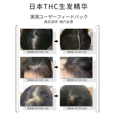 [King Health] Japanese hair growth liquid Japanese THC hair growth scalp essence TOPHAIRCODE hairline growth hair care anti-dense development hair one box 10ML other 30ml
