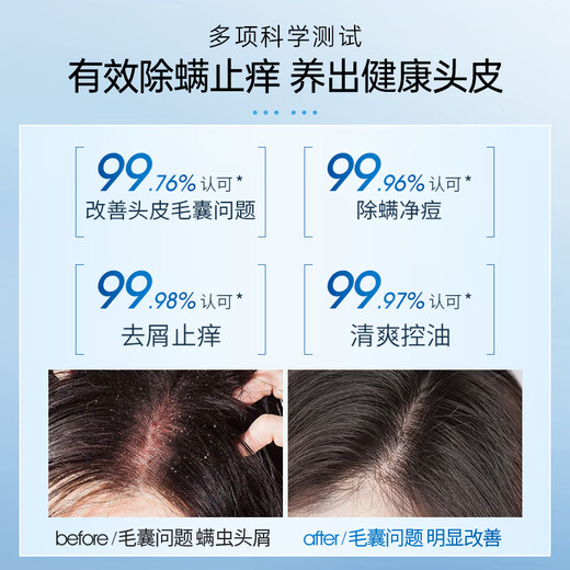 LOSOKI Suisse Suisse Follicule Hair Clean Thampooing Fat Donglai Contrôle de l'huile Contrôle de l'huile Inflammation anti-acné anti-phase pour hommes et femmes [Contrôle d'huile et démangeaisons] shampooing follicule pileux 300 ml