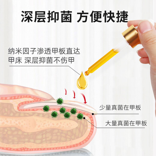 Chunchuntang Yunnan Herbal Onychomycosis Special Effect Chinese Herbal Antibacterial Liquid Thickening and Yellowing Hollow Onychomycosis Care Box