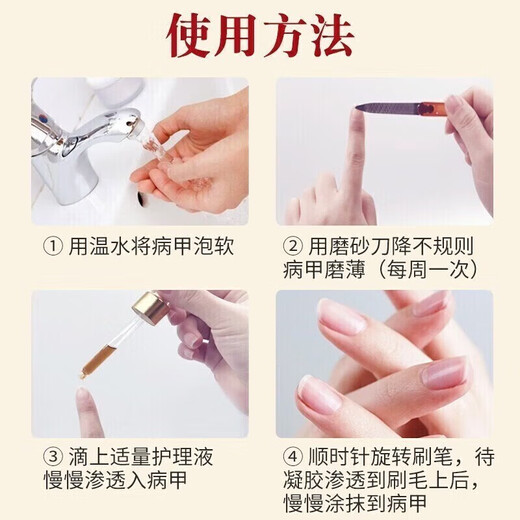 Lejia old store Nanjing Tongrentang special plaster for treating severe onychomycosis, nail fungus infection onychomycosis antibacterial liquid