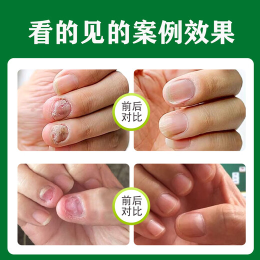 Correct onychomycosis antibacterial liquid, non-special effect, deck thickening and discoloration, nail groove fungal infection, impatiens sterilization and nail removal, 2 bottles of onychomycosis antibacterial liquid, moderate, no problem