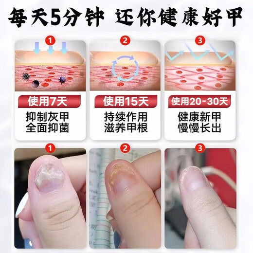Lejia old store Nanjing Tongrentang special plaster for treating severe onychomycosis, nail fungus infection onychomycosis antibacterial liquid