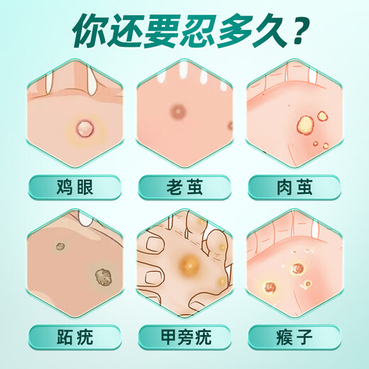 Yunnan herbal corn patch corn ointment to remove thorns on the roots of the feet, painless removal of flat warts, calluses on hands and feet, soles and toes warts