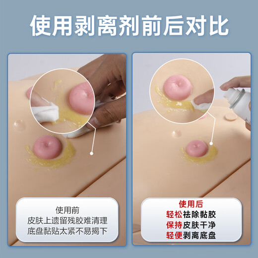 Enfermera compañera de clase Ostomy Pocket Chassis Adhesivo Spray Spray Medical Viscose Remover Stoma Care Products Remover Viscose [50 ml/botella] Remover adhesivo de chasis 12010