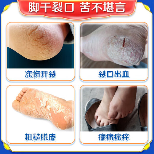 Hong Kong Pharmacy Cracked Heels Cream, Fungal Infection, Cracked and Peeling Feet, Anti-cracking, Moisturizing and Moisturizing Foot Cream w1, buy two and get one free, guaranteed to heal and prevent hair loss.