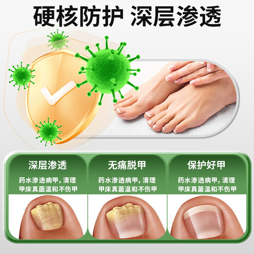 Chunchuntang Yunnan Herbal Onychomycosis Special Effect Chinese Herbal Antibacterial Liquid Thickening and Yellowing Hollow Onychomycosis Care Box