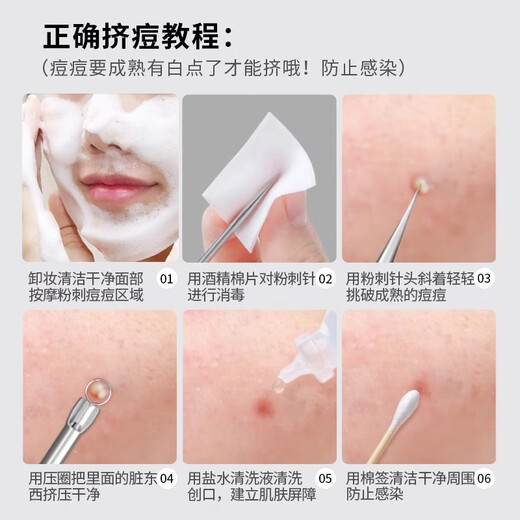 Keqi Double-headed Acne Needle to Remove Blackheads and Acne Acne Acne Picking Acne Special Cleaning Tool Tweezers 5 Pieces